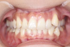 八重歯の矯正 半年の変化 カレブラン Carre Blanc 矯正歯科 恵比寿