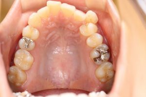 八重歯の矯正 半年の変化 カレブラン Carre Blanc 矯正歯科 恵比寿