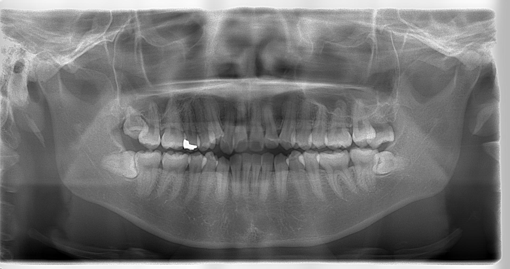 歯は全部で何本 カレブラン Carre Blanc 矯正歯科 恵比寿